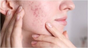 Effective Skin Care Range for Acne Treatment