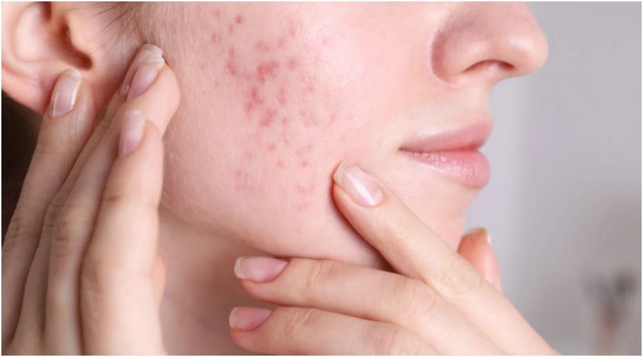 Effective Skin Care Range for Acne Treatment