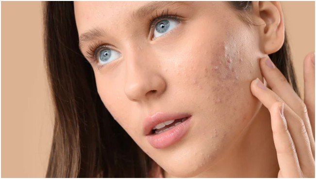 The Importance of a Targeted Skin Care Range for Acne