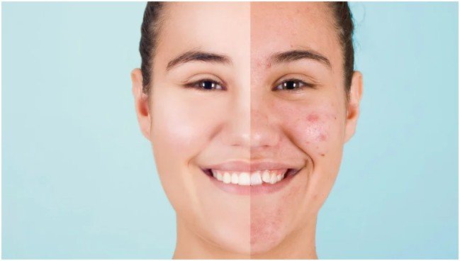 Benefits of Consistent Use of Acne Skin Care Products